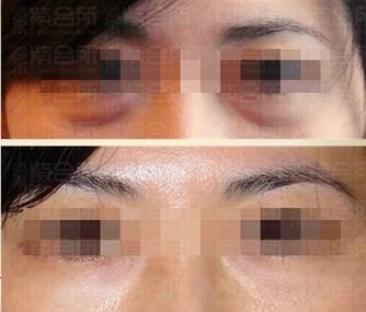 紫會(huì)所引進(jìn)韓國(guó)美塑槍除皺減肥效果好