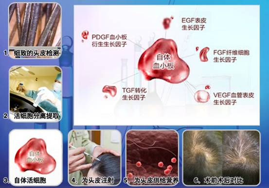 科發源的新傳奇:ST自體活細胞應用