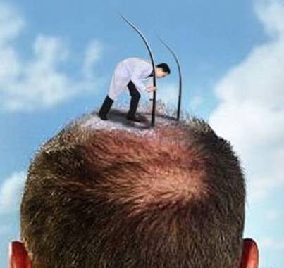 新疆有植發的嗎 新疆人植發要去哪？