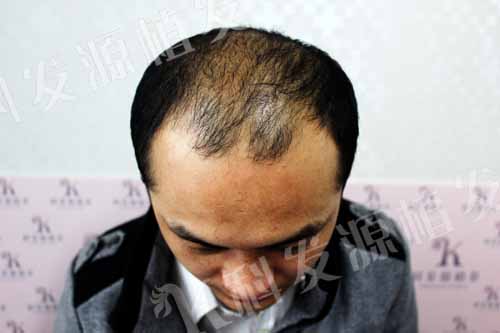 張青松：我之最 一次植發三種技術