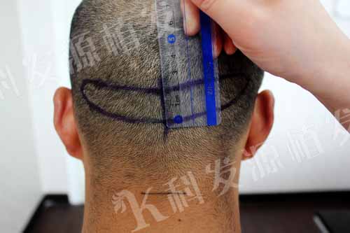 張青松：我之最 一次植發三種技術